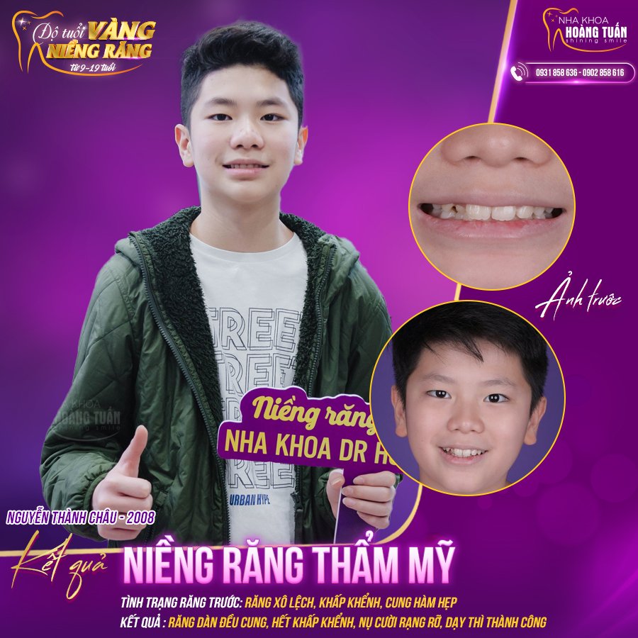 Niềng răng trẻ em