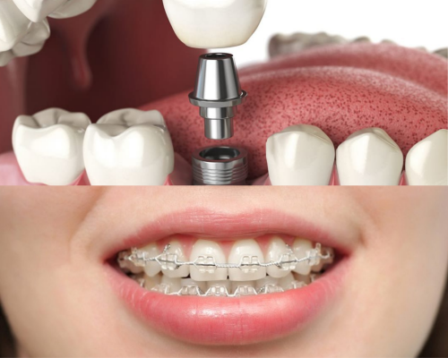 trồng răng implant có niềng răng được không