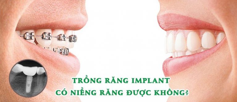 trồng răng implant có niềng răng được không