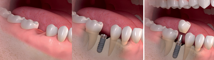 Trồng răng implant mất bao lâu