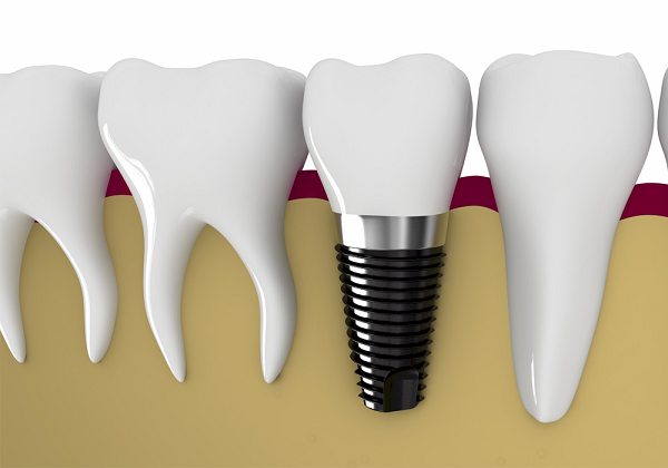 Trồng răng implant mất bao lâu