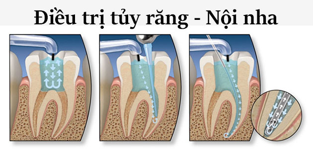 điều trị tủy răng không đau