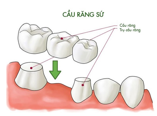 làm cầu răng sứ có đau không