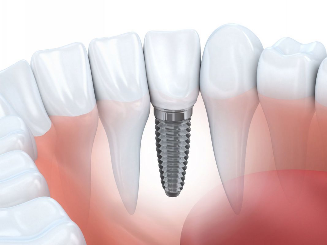 nên làm cầu răng sứ hay trồng implant