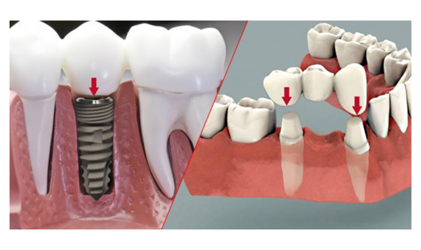 nên làm cầu răng sứ hay trồng implant