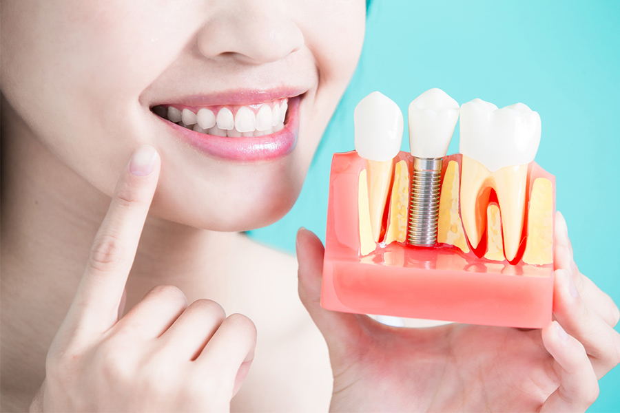 trồng răng implant giữ được bao lâu