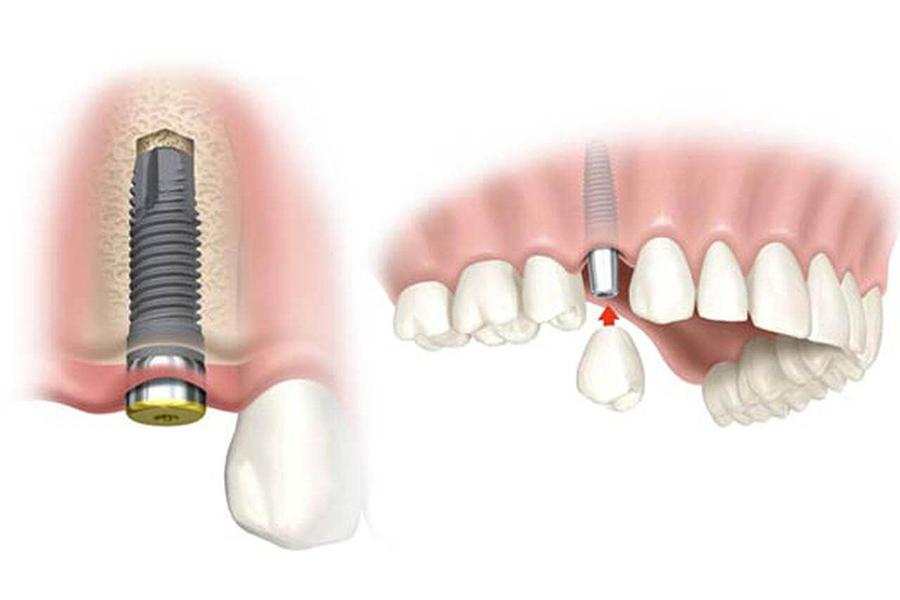 trồng răng implant giữ được bao lâu