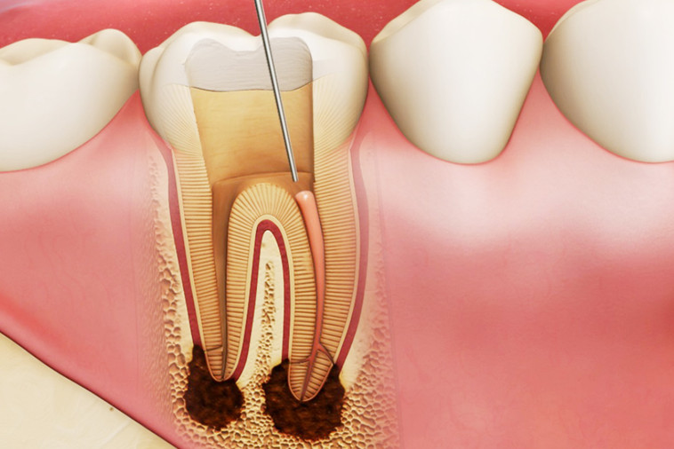 điều trị tuỷ răng xong có đau không