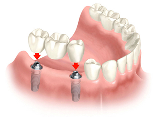 làm cầu răng sứ có bền không