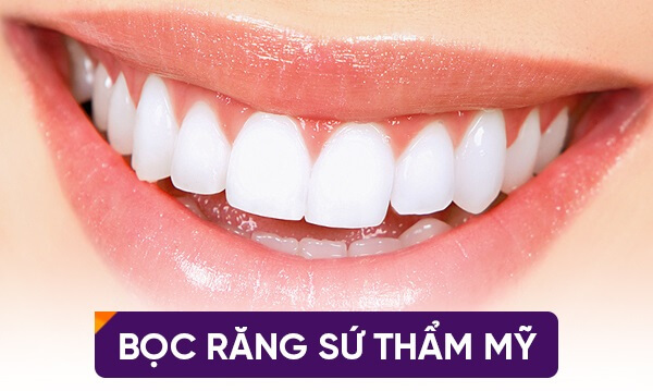 kinh nghiệm bọc răng sứ thẩm mỹ