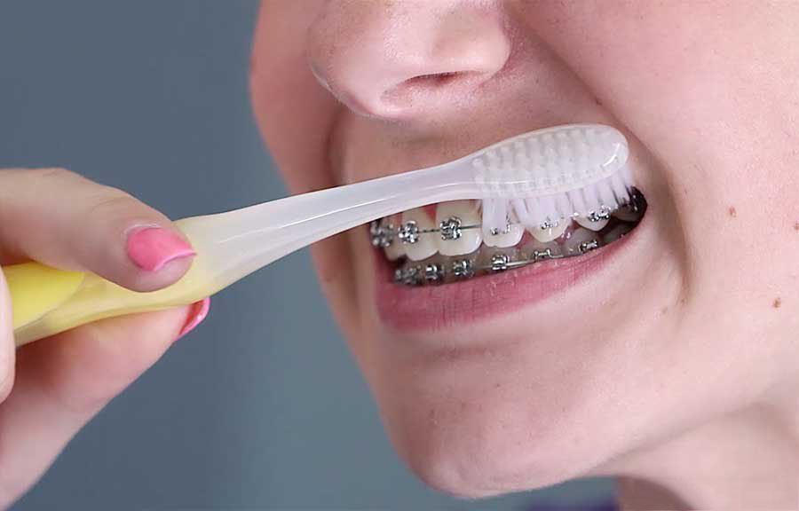 Niềng răng giúp việc vệ sinh răng miệng dễ dàng hơn