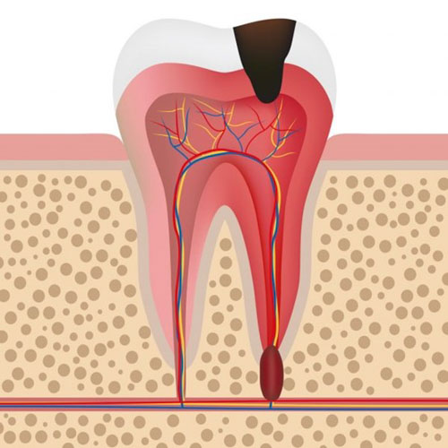 phương pháp điều trị tuỷ răng