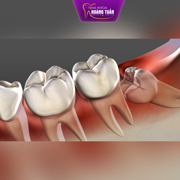 Nhổ răng khôn là một tiểu phẫu trong nha khoa