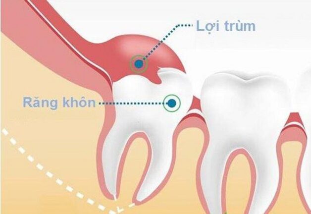 Răng khôn bị kẹt