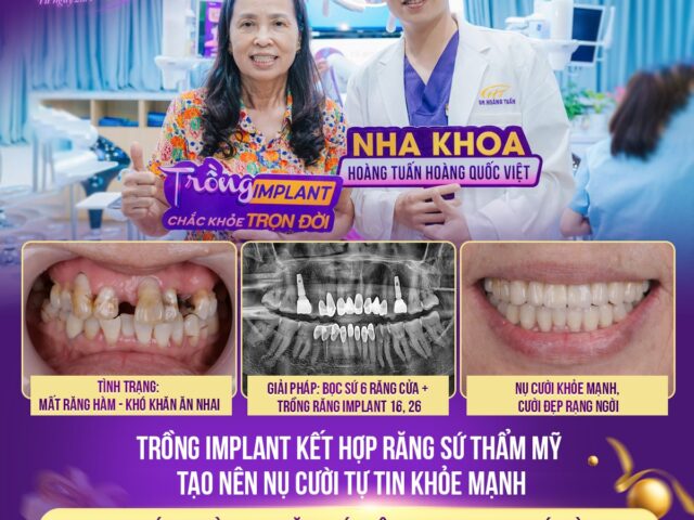 cô Trần Thị Nga -1960 - thực hiện trồng implant