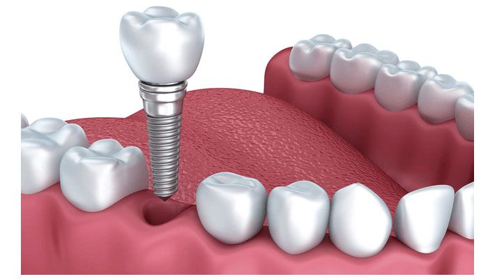 Khái niệm trồng răng Implant