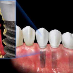 Biến chứng sau trồng răng Implant