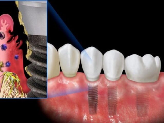 Biến chứng sau trồng răng Implant