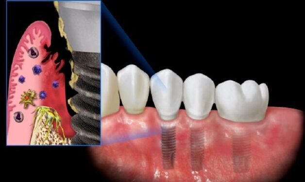 Nhiễm trùng sau trồng răng implant