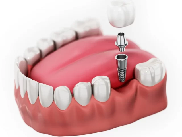 Những lưu ý để trụ implant không bị đào thải