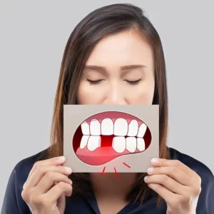 Mất răng