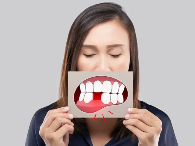 Mất răng