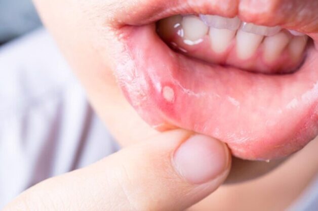 Nhiệt miệng là gì?