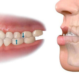 Khớp cắn ngược