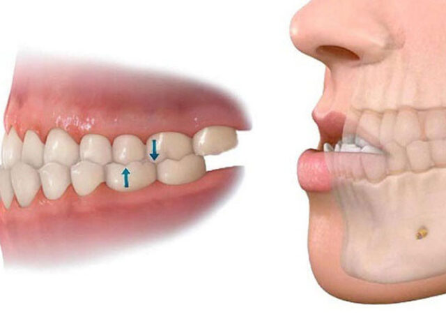 Khớp cắn ngược