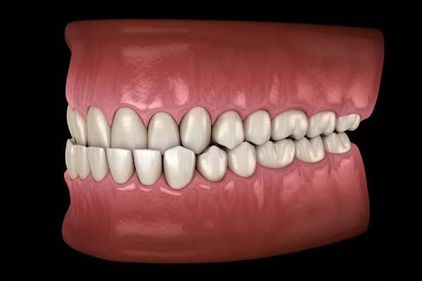 Khớp cắn ngược là gì?