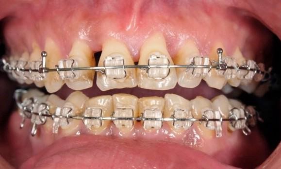 Niềng răng bị tụt lợi