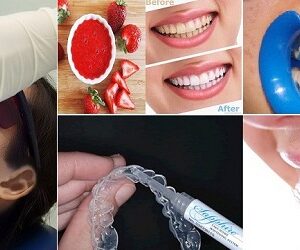 So sánh tẩy trắng răng tại nhà và tại nha khoa
