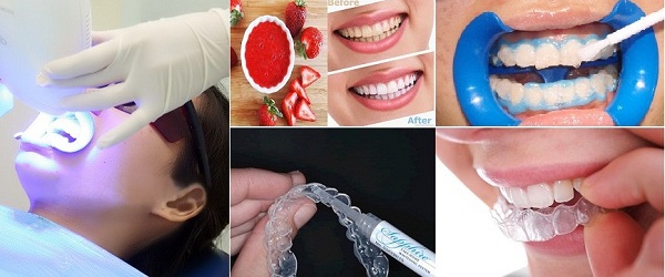 So sánh tẩy trắng răng tại nhà và tại nha khoa