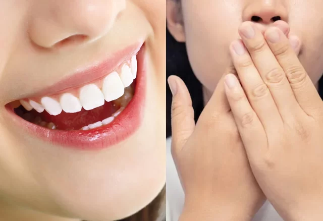 Bọc răng sứ bị hôi miệng