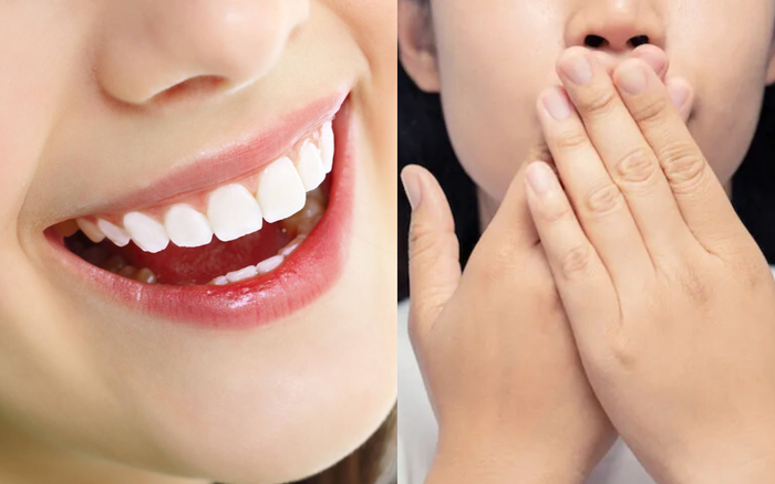 Bọc răng sứ bị hôi miệng