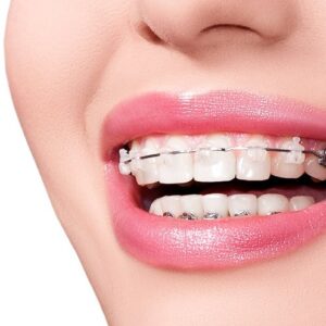 Niềng răng có cho kết quả vĩnh viễn không
