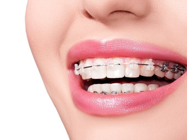 Niềng răng có cho kết quả vĩnh viễn không