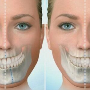 Niềng răng có hết lệch mặt không?