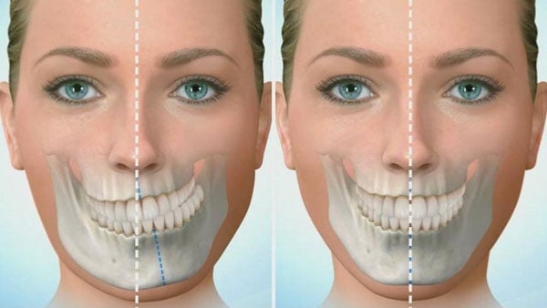 Niềng răng có hết lệch mặt không?
