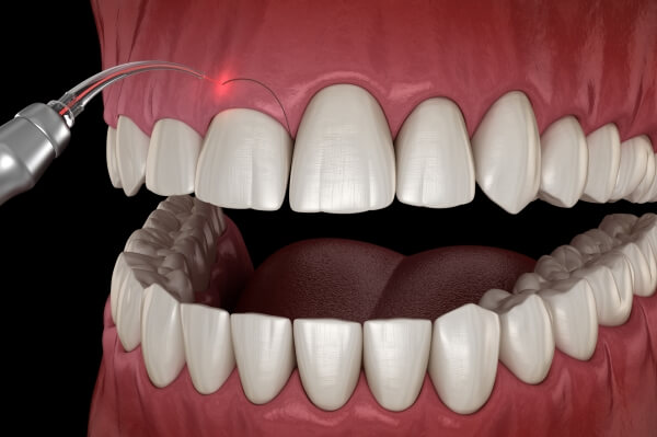 phẫu thuật cười hở lợi
