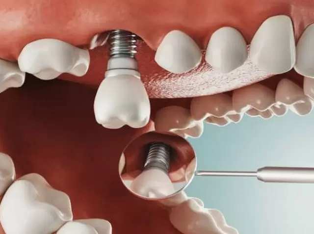 trồng răng implant có bị đào thải không