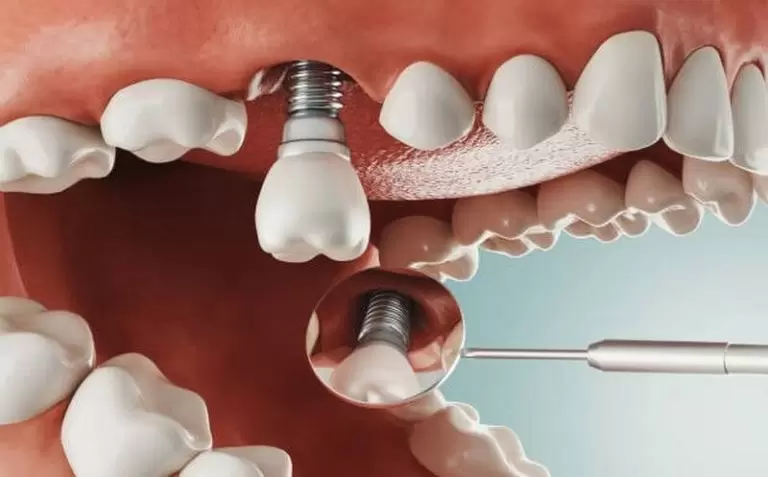 Trồng răng implant có bị đào thải không